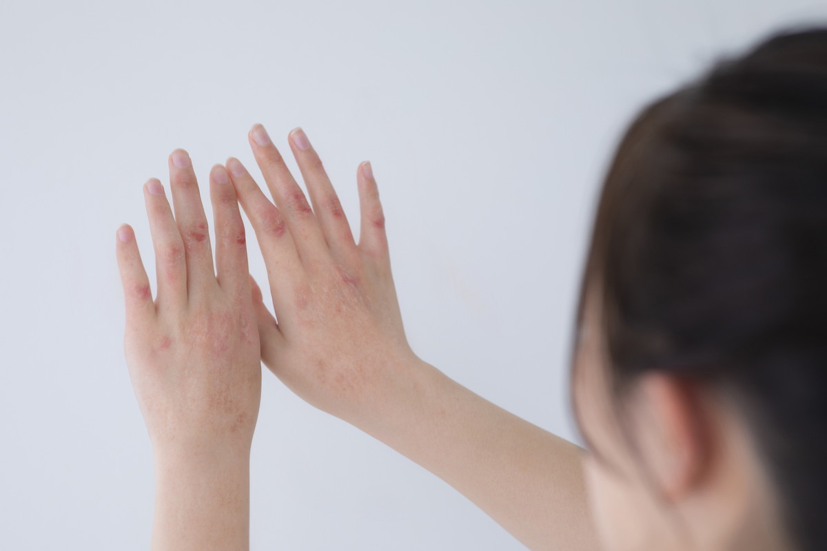 アトピー性皮膚炎が悪化する原因とは？